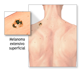 Melanoma